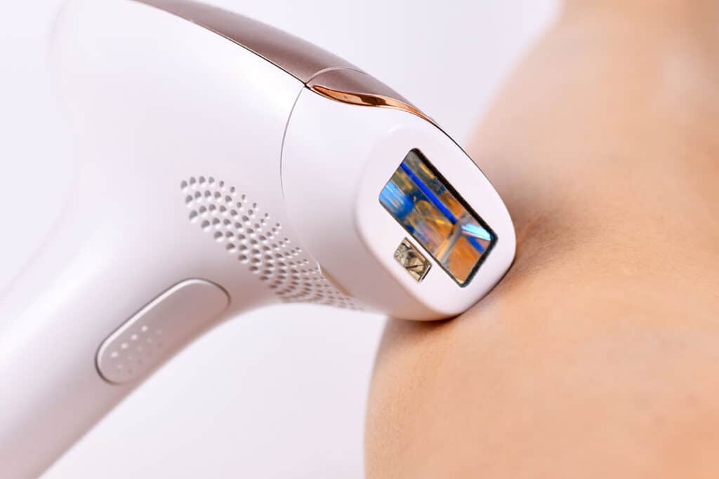 laser hair removal