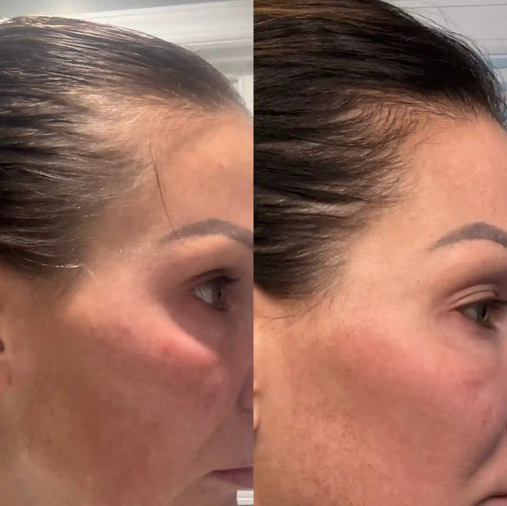non-surgical hair restoration before and after image of a woman