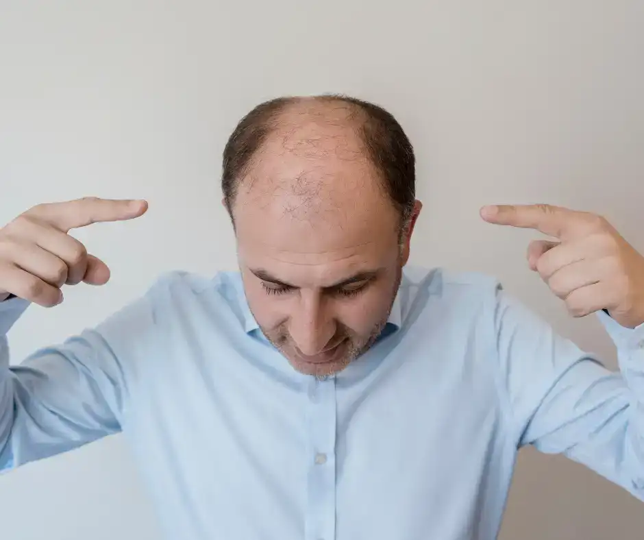 male pattern baldness
