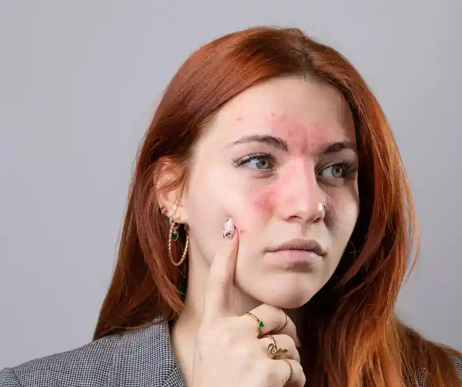 Rosacea Treatment in Airmont NY