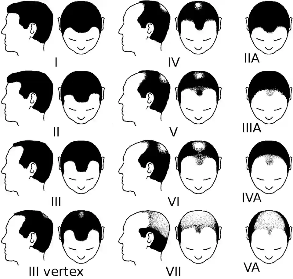 norwood scale