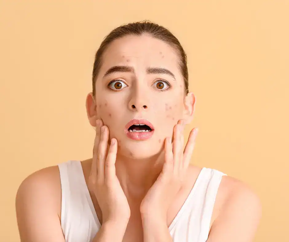 girl with acne on her face