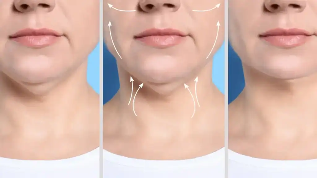 jowls in face