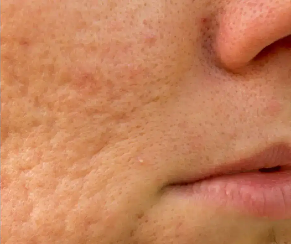ice pick scars - acne type