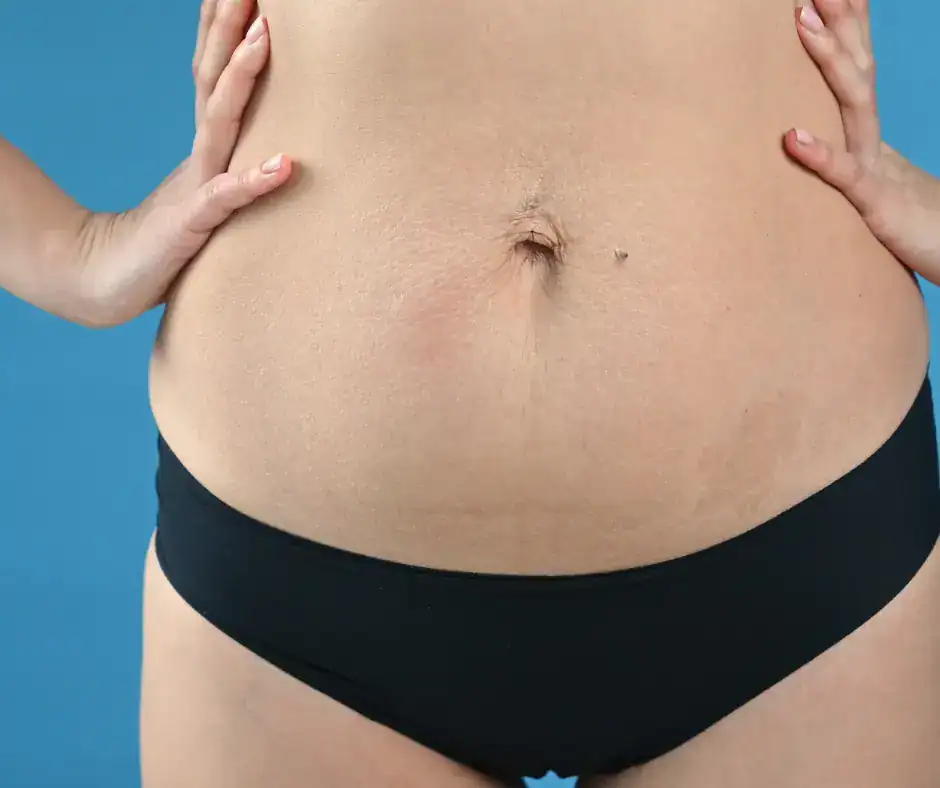 diastasis recti