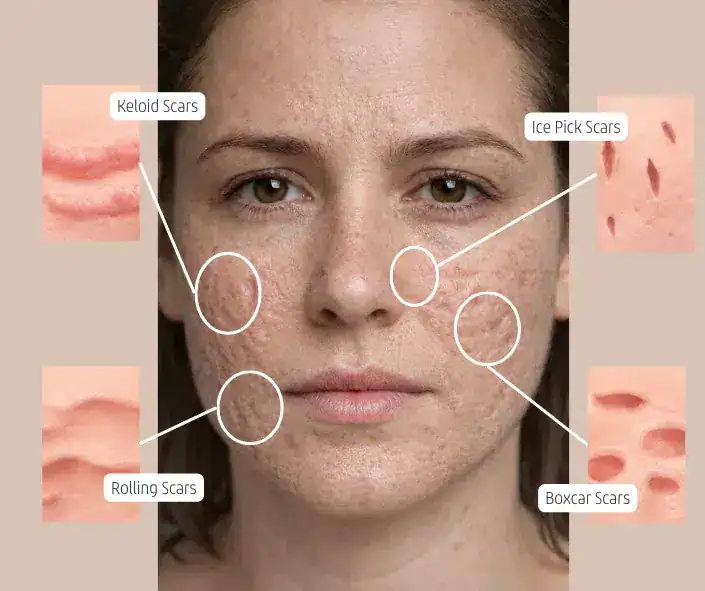 types of acne scars