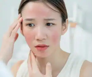 woman suffering rosacea on the face