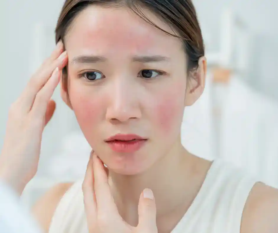 woman suffering rosacea on the face
