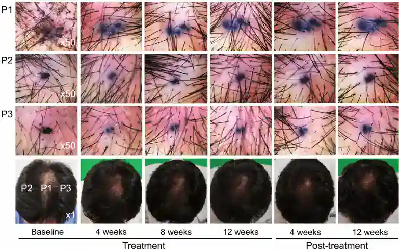 Hair follicle analysis under microscope showing growth stages and treatment results.