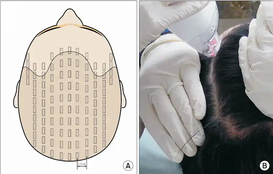 Close-up of a person receiving head lice treatment with a healthcare professional.