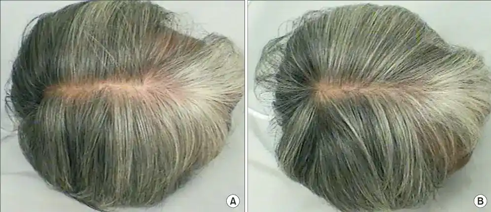 Gray hair before and after treatment at Parpar clinic.