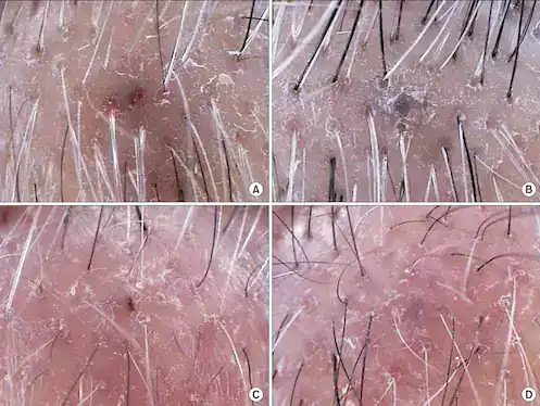 Close-up of hair follicle extraction procedure showing skin and hair removal tools.