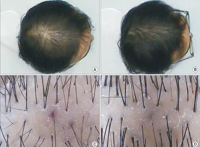 Hair regrowth transformation with advanced scalp treatment.