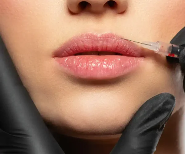 lip filler procedure - belotero lips shape