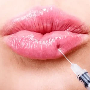 belotero lips shape filler injection