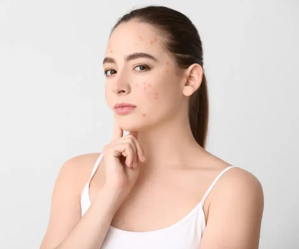 face has acne scars