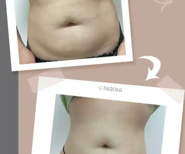 adominal muscle toning before and after