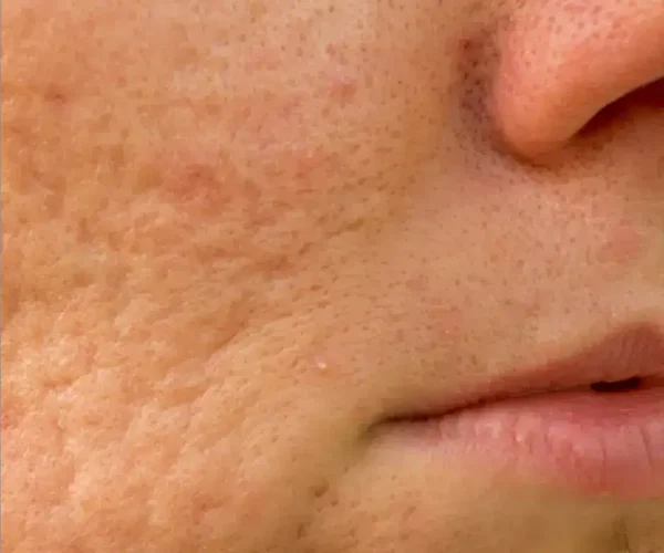 ice pick scars - acne type