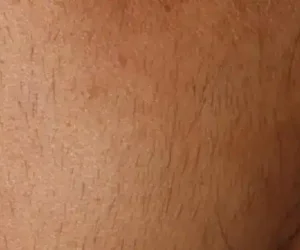 before and after result laser hair removal 4