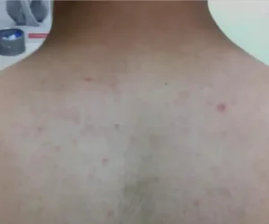 back before and after result of laser hair removal using clarity II