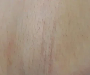 underarm before and after result laser hair removal 4
