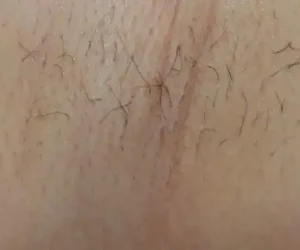 underarm before and after result laser hair removal with clarity II