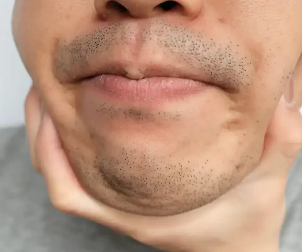 male stubble - facial laser hair removal for men's mustache