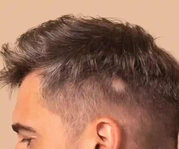 men with alopecia