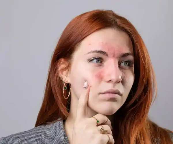 Rosacea Treatment in Airmont NY