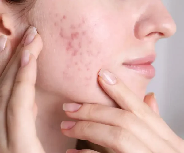 Acne scars on cheeks