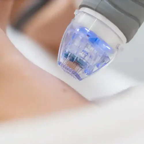 microneedling treatment for acne scars