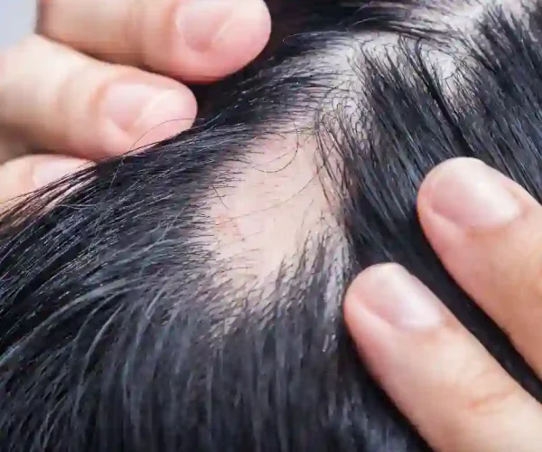 alopecia spot